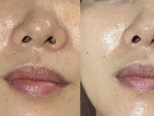 ビジュー(BIJOU)/プラピール＋EMSシートパック