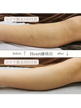 ハート 藤枝店(Heart)/ひざ下ジュニア脱毛　CLEAR/ＳＰ