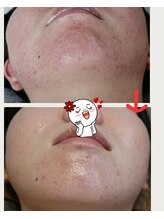 ベビースキン(baby skin)/肌改善