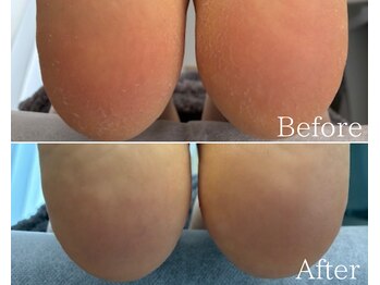 カシェット 広島店(Cachette)/50代女性☆足裏角質ケア90分