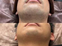 メンズ脱毛サロン ボス(BOSS)/ヒゲ脱毛で清潔感UP！＃ヒゲ脱毛