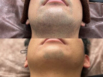 メンズ脱毛サロン ボス(BOSS)/ヒゲ脱毛で清潔感UP！＃ヒゲ脱毛