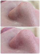 アキュネ 福岡薬院店(acune)/毛穴洗浄/福岡/美容鍼/美肌