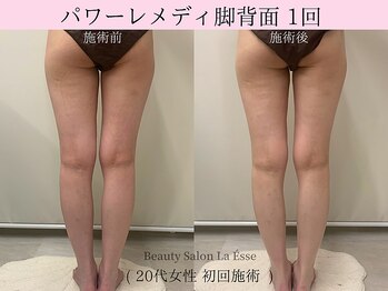 ラエッセ(La Esse)/パワーレメディで隙間作り