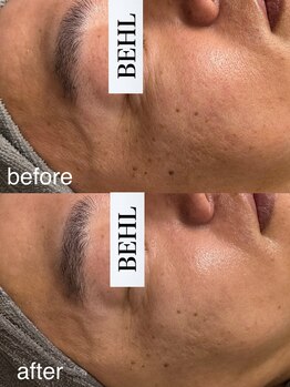 ベール(BEHL)/石膏パックのBefore After