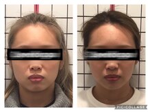 堺整骨院 小郡院/小顔矯正