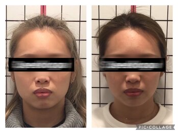 堺整骨院 小郡院/小顔矯正
