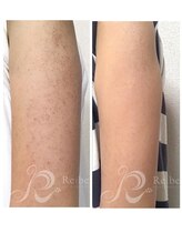 ビープラス(Biplus)/二の腕のブツブツ