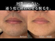 ダイヤ 名古屋中川区店(Daiya)/3回で濃かった髭が激変！正面