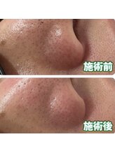 サロン ド ミコラ(salon de Micora)/【毛穴ケア】次世代毛穴洗浄！