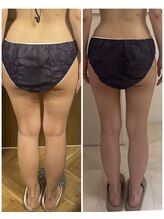 メロウプラス 錦糸町店/脚のセルライトケア　