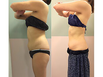 グッドライフエステの写真/【ぽっこりお腹・背中のお肉に】気になるお肉に徹底アプローチ!40代からのダイエットは当店にお任せ!