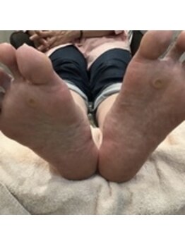 ネイルデコ(nail DECO)/フット角質ケアコース(ケア後)