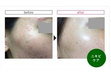 ベルメイク(BELLE MAKE)/シルク肌ハーブピーリング☆