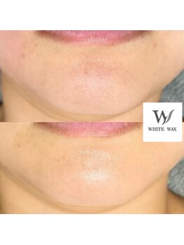 ホワイトワックス 京都四条烏丸(WHITE WAX)/口周り 毛穴の黒ずみごっそり◎
