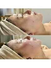 サロン ド ブラン アオヤマ(Salon de BLANC AOYAMA)/ビオフィート×ソノケア