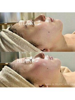 サロン ド ブラン アオヤマ(Salon de BLANC AOYAMA)/ビオフィート×ソノケア