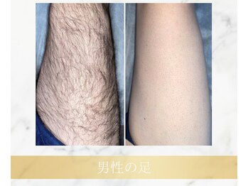 アンド エヌ(&n)/◆足脱毛◆