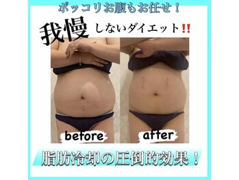 アールズ スリム(R's slim)/脂肪冷却ダイエット◎痩身