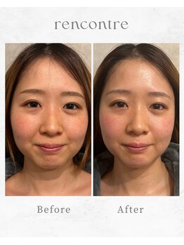ランコント(rencontre)/毛穴/ヘッドスパ/小顔/リンパ