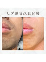 ボゴス(BOGOSS)/ヒゲ脱毛20回照射