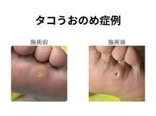 ドクターネイル爪革命 和歌山/胼胝魚の目