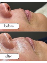 アール(R;)/口周りの産毛もワックスで綺麗に