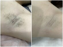 シェリアン バイ アイビー(Cherien by IVY)/脇脱毛