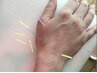 【スマホ指/マウスけんしょうえん/ばね指】全身鍼灸+手指の特殊鍼90分¥13000