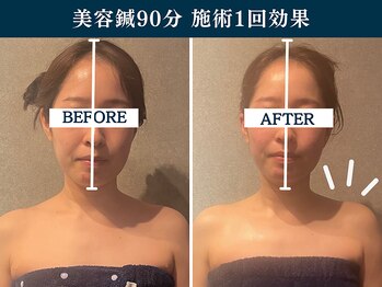 シンク 表参道(CINQ)/ブライダルケアも大人気の美容鍼