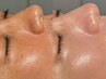 【毛穴ケア】毛穴悩み第2位［黒ずみ毛穴］集中改善プラン　16500