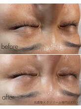 エクソ 吉祥寺(EXO)/目元の小じわも改善