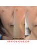 肌の土台（内側）からケア！美肌効果も抜群【Eライトフェイシャルエステ】