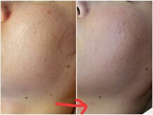 ベビースキン(baby skin)/毛穴改善