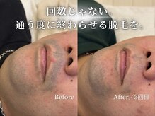 ダイヤ 名古屋中川区店(Daiya)/メンズ脱毛/ヒゲ【BeforeAfter】