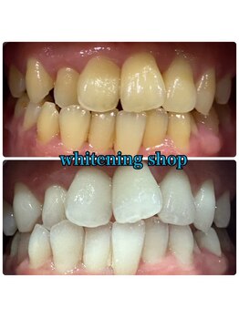 ホワイトニングショップ 鈴鹿店/Before&After美白ホワイトニング