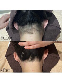 ラヴァン(LaVan)/うなじ脱毛