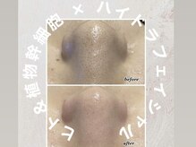 エンチャント(ENCHANT)/★ハイドラ毛穴洗浄★