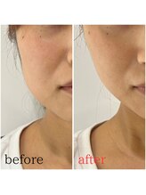 モアビューティー 紙屋町店/フェイスライン集中ケア！