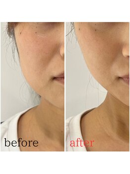 モアビューティー 紙屋町店/フェイスライン集中ケア!