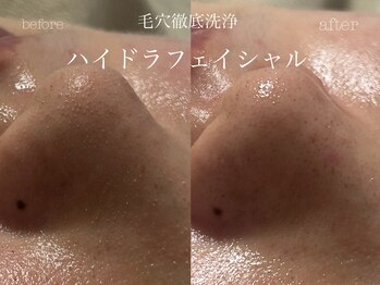 キアラ(CHIARA)/ハイドラフェイシャル