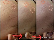 ベビースキン(baby skin)/肌改善