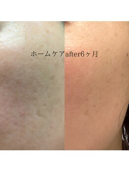 ララ(LaLa.)/ハーブピーリング+ホームケア