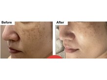 トゥルートラストディーバ 大里店(DIVA)/エクソソーム導入