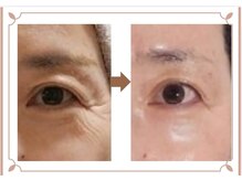 アン 銀座(ann)/小ジワたるみにはエクソソーム