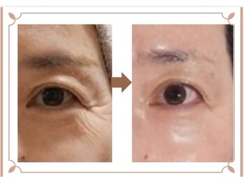 アン 銀座(ann)/小ジワたるみにはエクソソーム