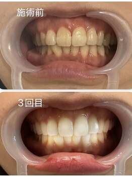 スマイルホワイト/30代男性