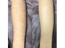 シェリー(Cherie)の雰囲気（キッズ脱毛！綺麗な素肌へ）