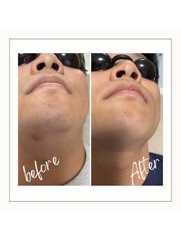 フルールスレーヌ(Fleur Sereine)/清潔感が一番☆本気の髭脱毛