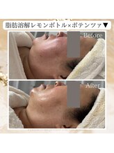ビヌ(Binu)/脂肪分解レモンボトル・小顔ケア